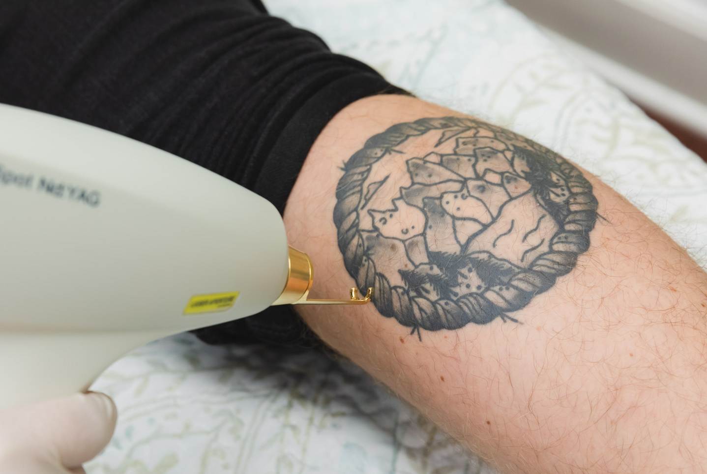 How Tattoo Removal Works - PureMD