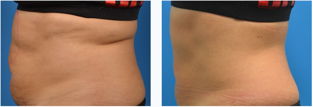 SculpSure