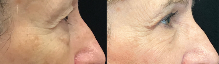AccutiteMorpheus-periorbital-before-after
