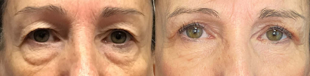 AccutiteMorpheus-upper-and-lower-eyelids