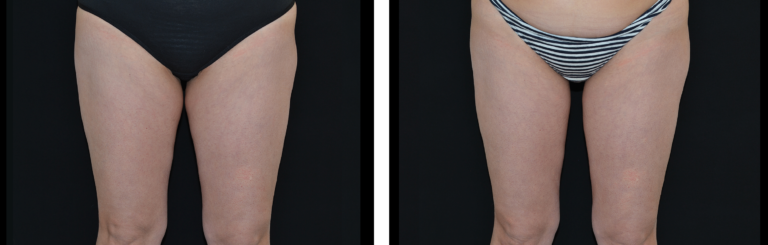 BTL-Exilis-legs-BTL-Exilis-btl-exilis-8tx
