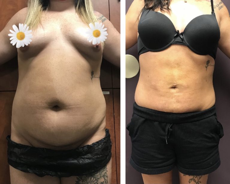 BodytiteLip-SmartLipo-2M-after