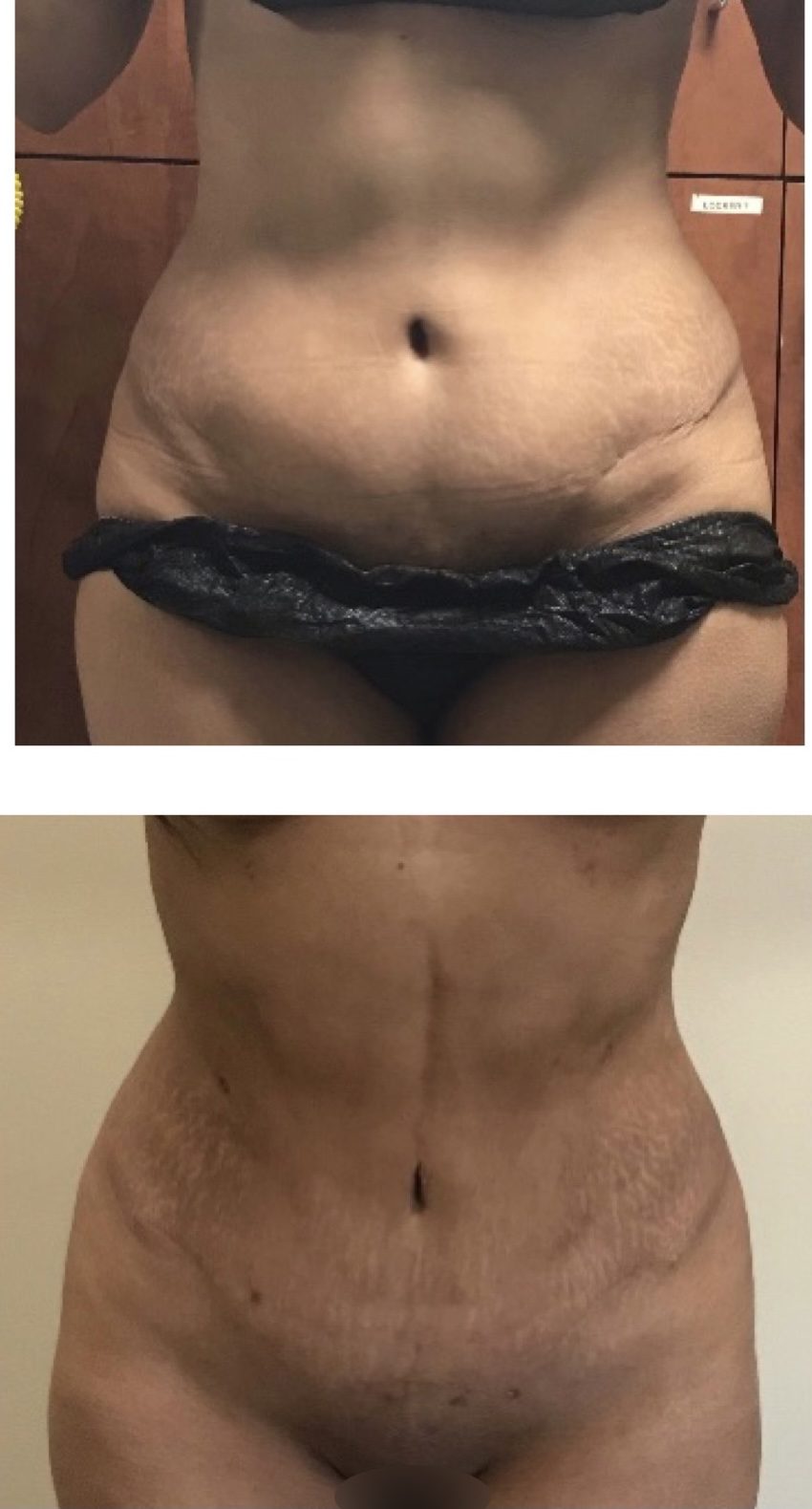 BodytiteLipo-1M