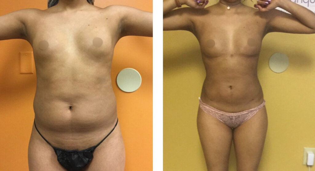 BodytiteLipo