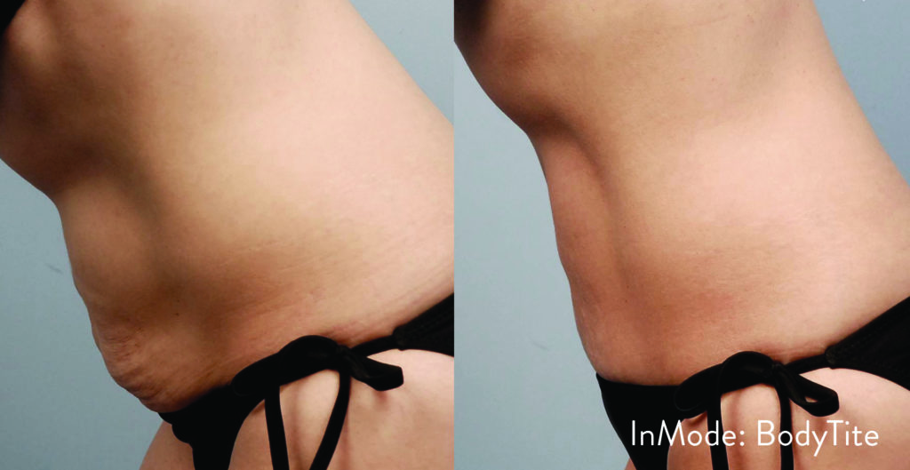 BodytiteLipo-IM_SM-MommyTummy