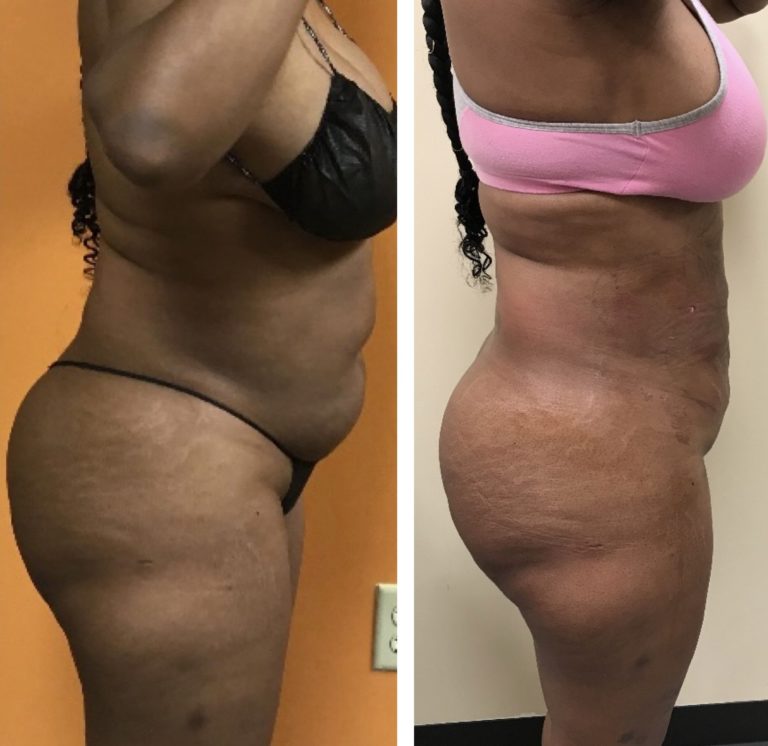 BodytiteLipo-ONE-day-post-SmartLipo