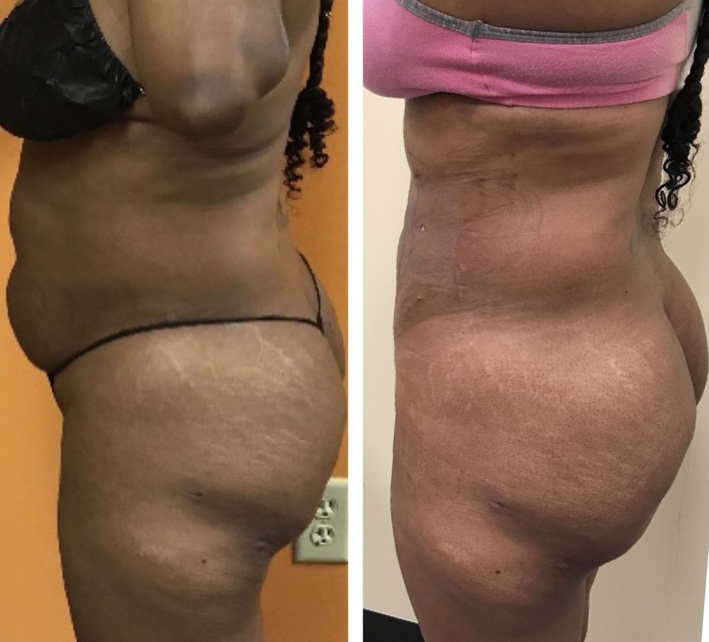 BodytiteLipo-ONE-day
