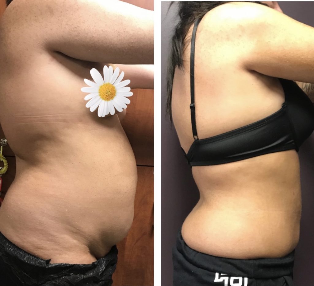 BodytiteLipo-SmartLipo-2M-after