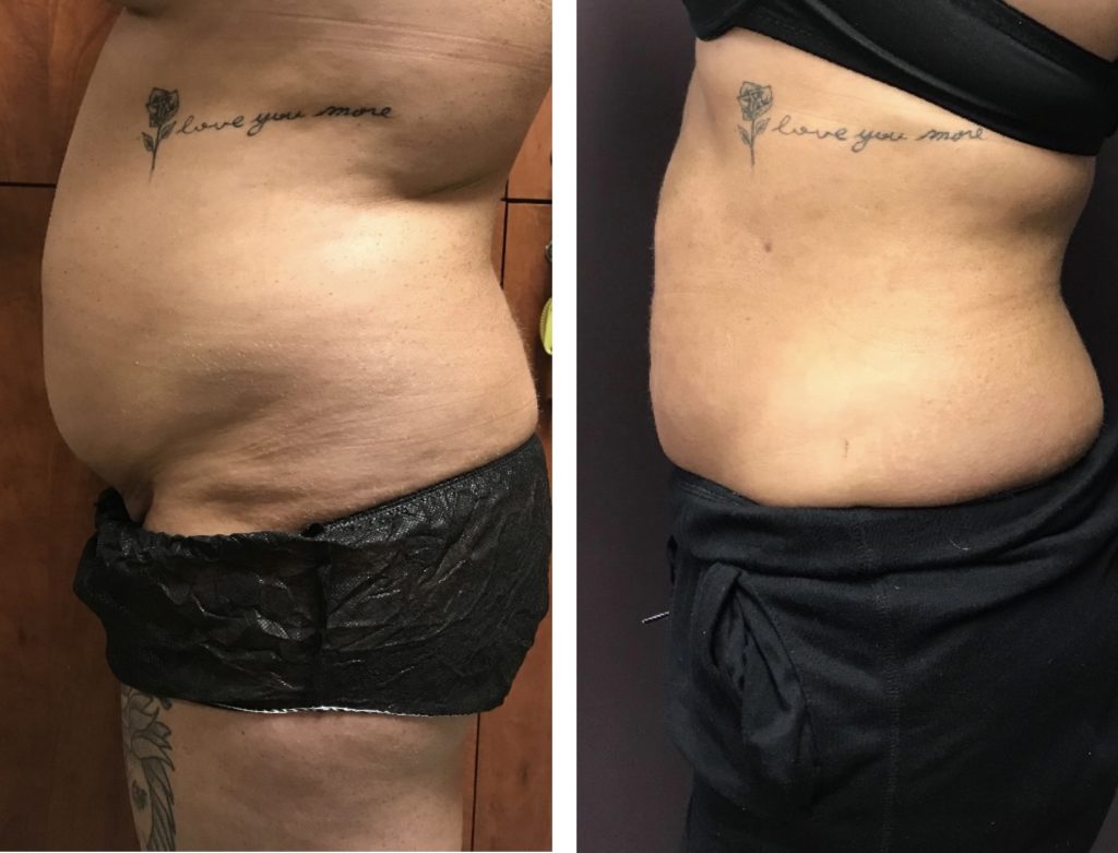 BodytiteLipo-SmartLipo-2M-after