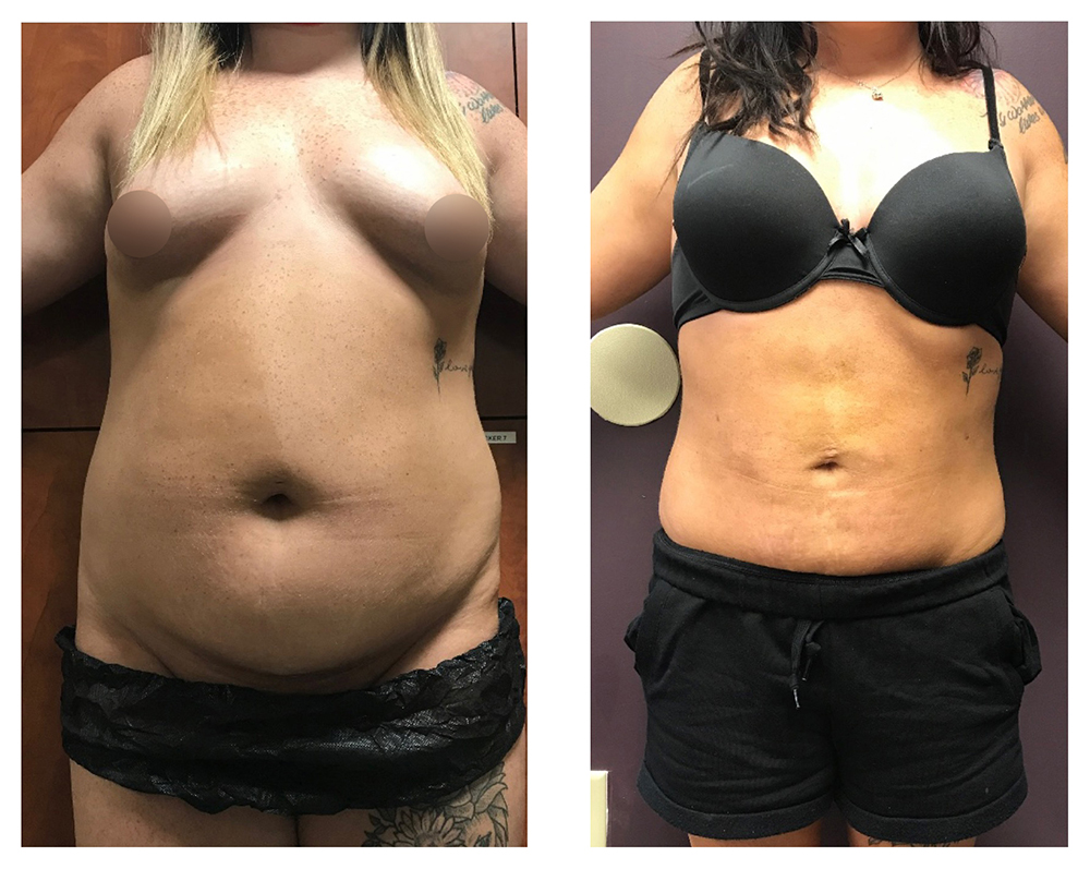 BodytiteLipo-SmartLipo-2M-after