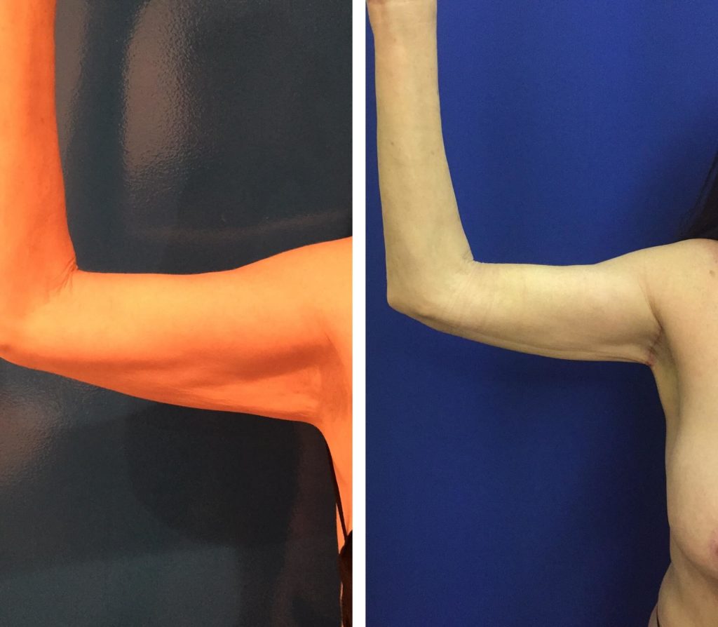 BodytiteLipo-arms-lipo