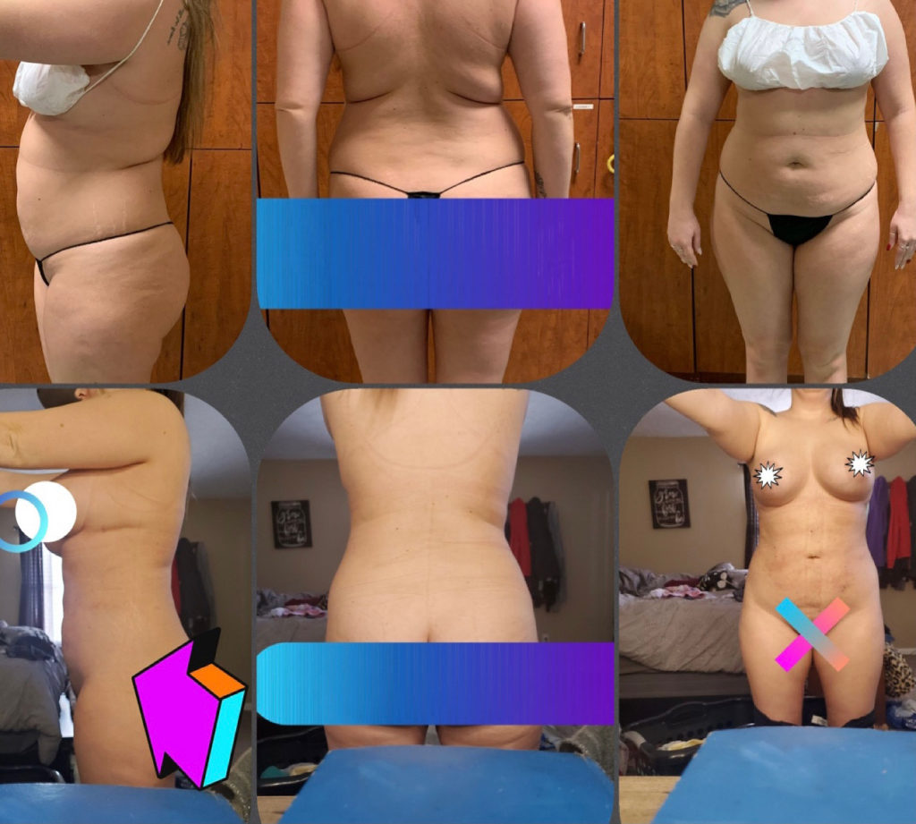 BodytiteLipo-lipo-360-and-fat-transfer-2M
