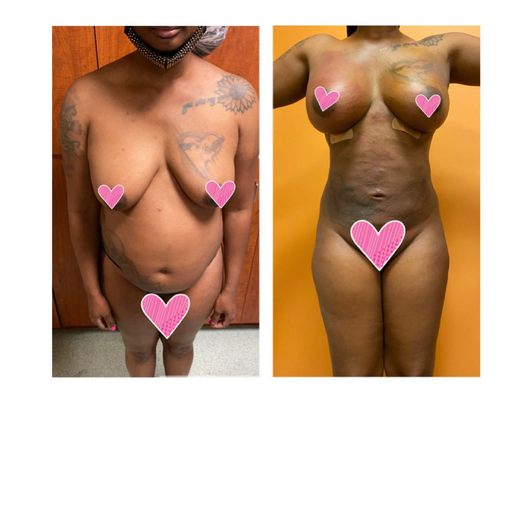 BodytiteLipo-lipo-360-and-fat-transfer