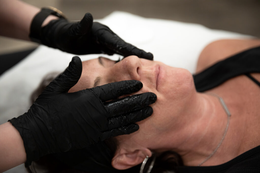 Chemical-Peel