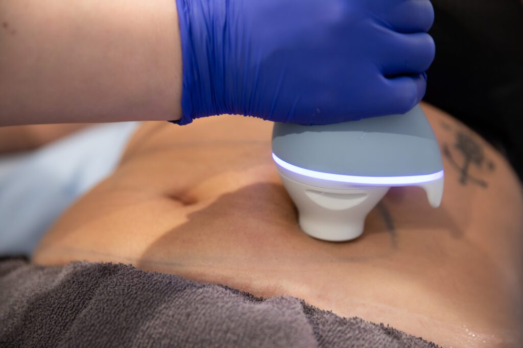 Coolsculpting