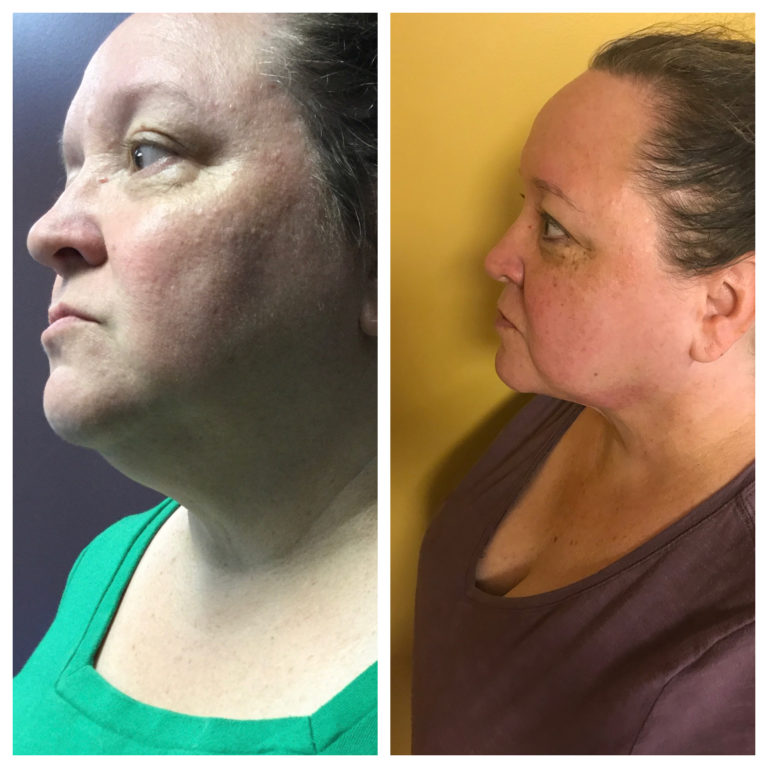 Facetitelipo-Facetite-Smart-Lipo-3M