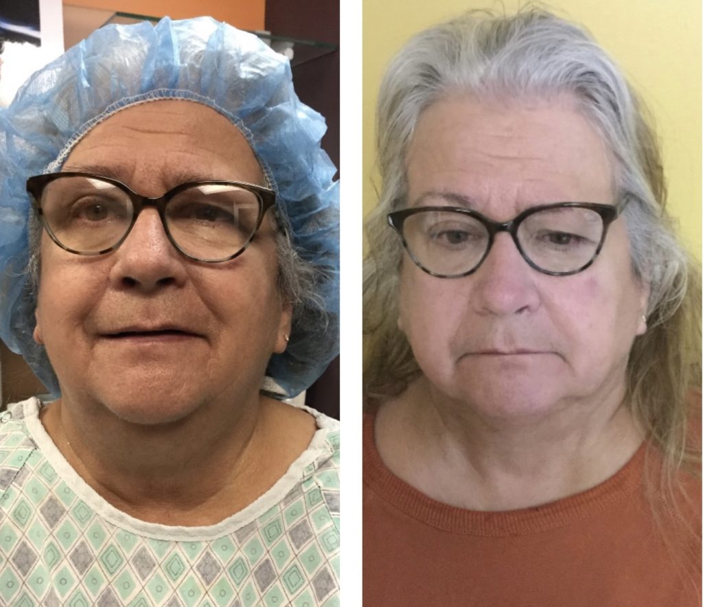 Facetitelipo-Facetite-SmartLipo-3M-after
