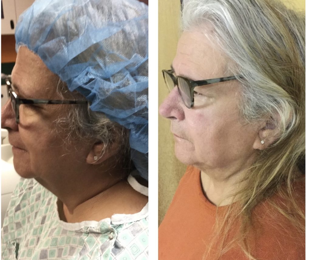Facetitelipo-Facetite-SmartLipo-3M-after