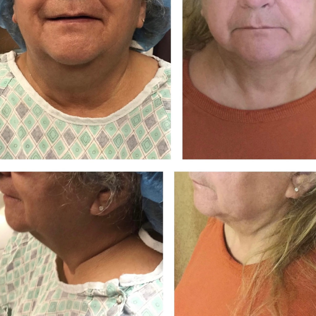 Facetitelipo-Facetite-SmartLipo-3M-after