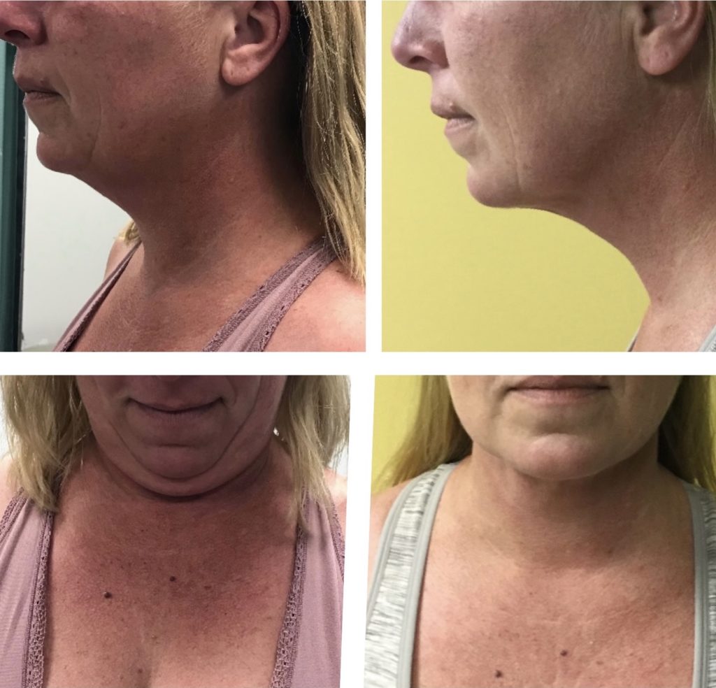 Facetitelipo-Facetite-SmartLipo