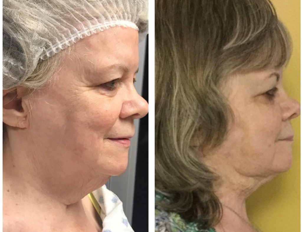 Facetitelipo-Facetite-SmartLipo 4 weeks-after