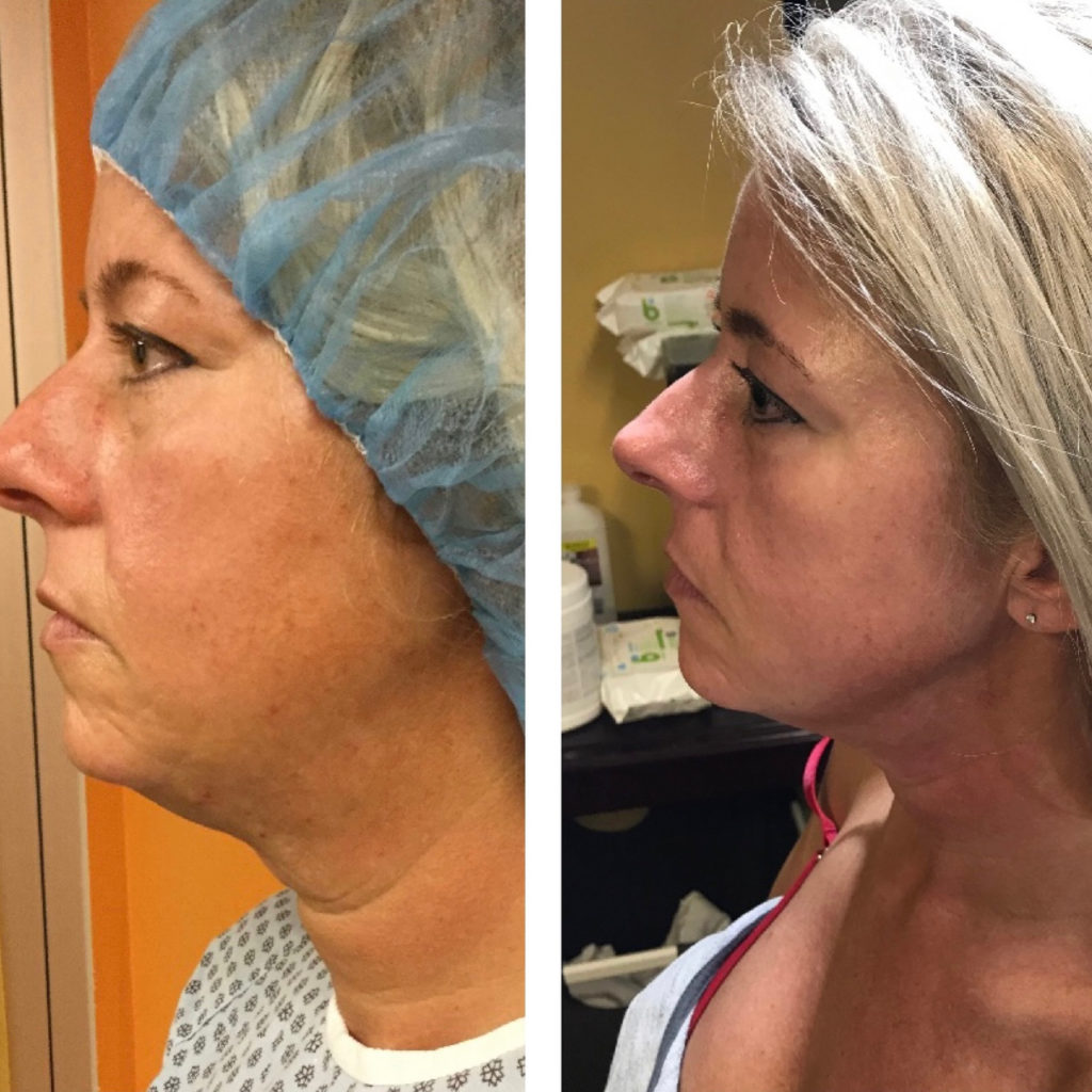 Facetitelipo-Facetite-SmartLipo-5-weeks-after