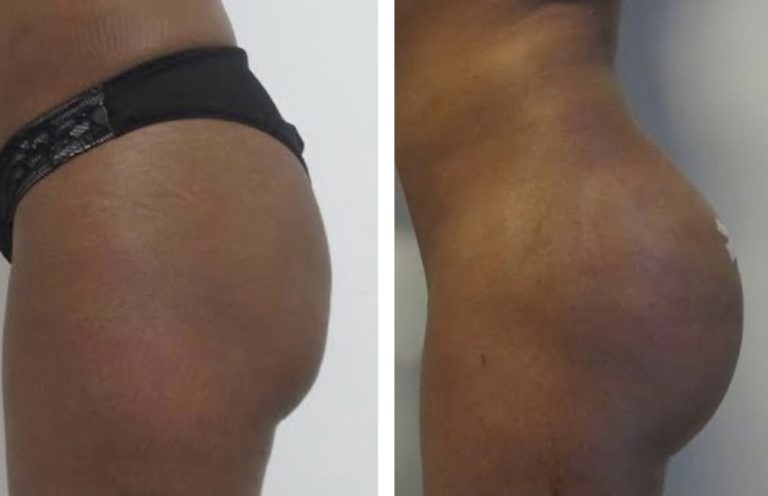 Fat-Transfer-1-week-after