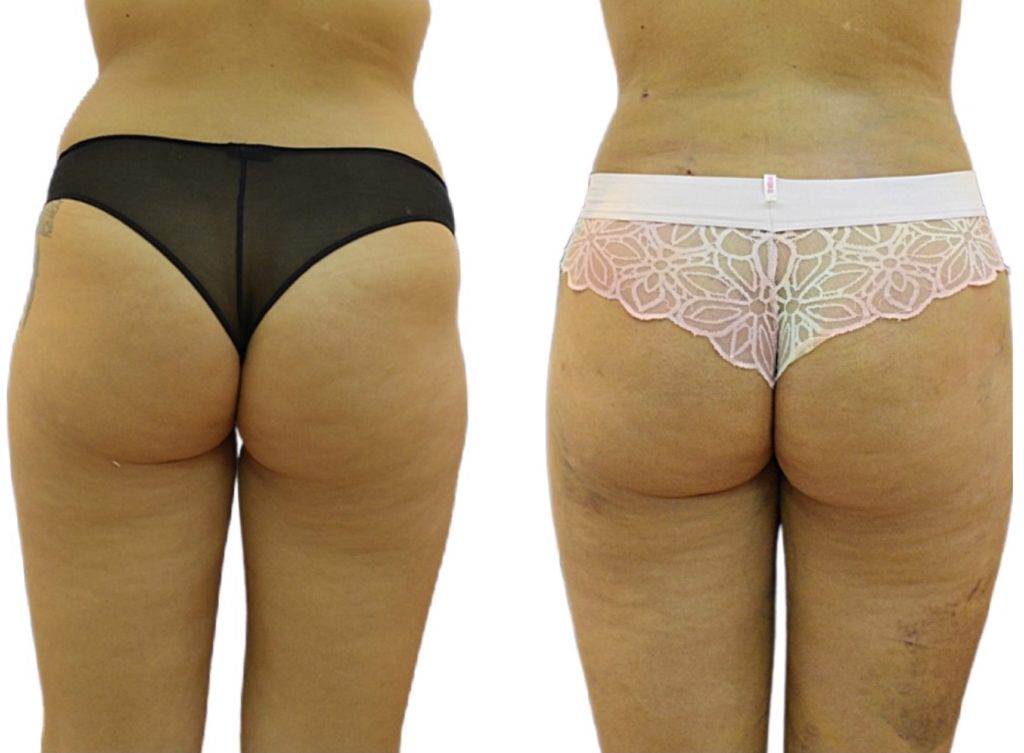 Fat-Transfer-1M-after