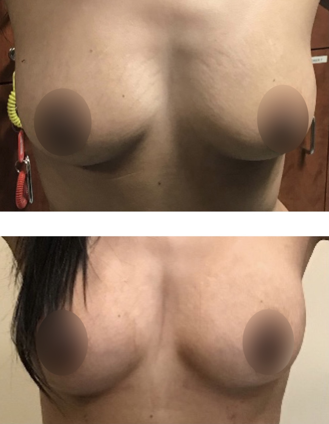 Fat-Transfer-1M-post-fat-transfer-blur