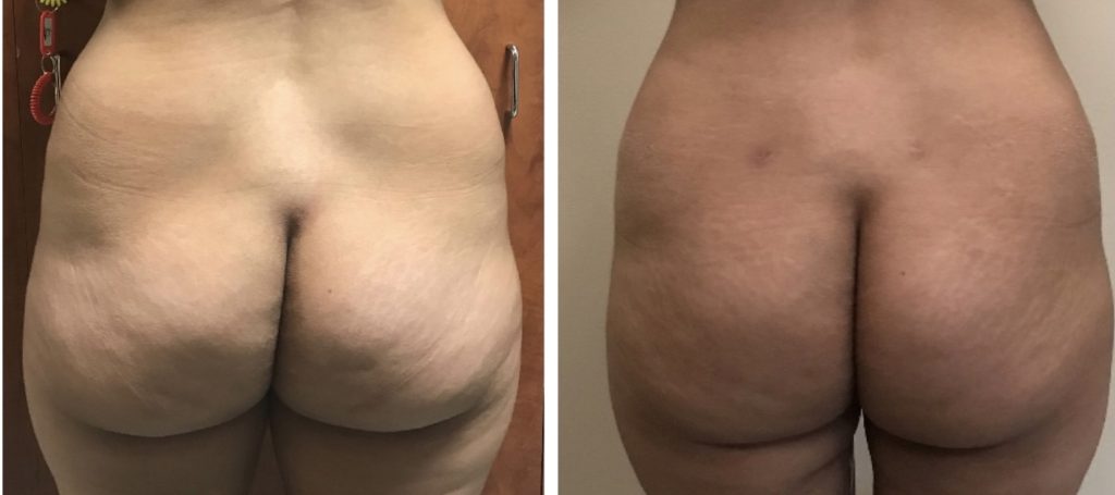 Fat-Transfer-1M