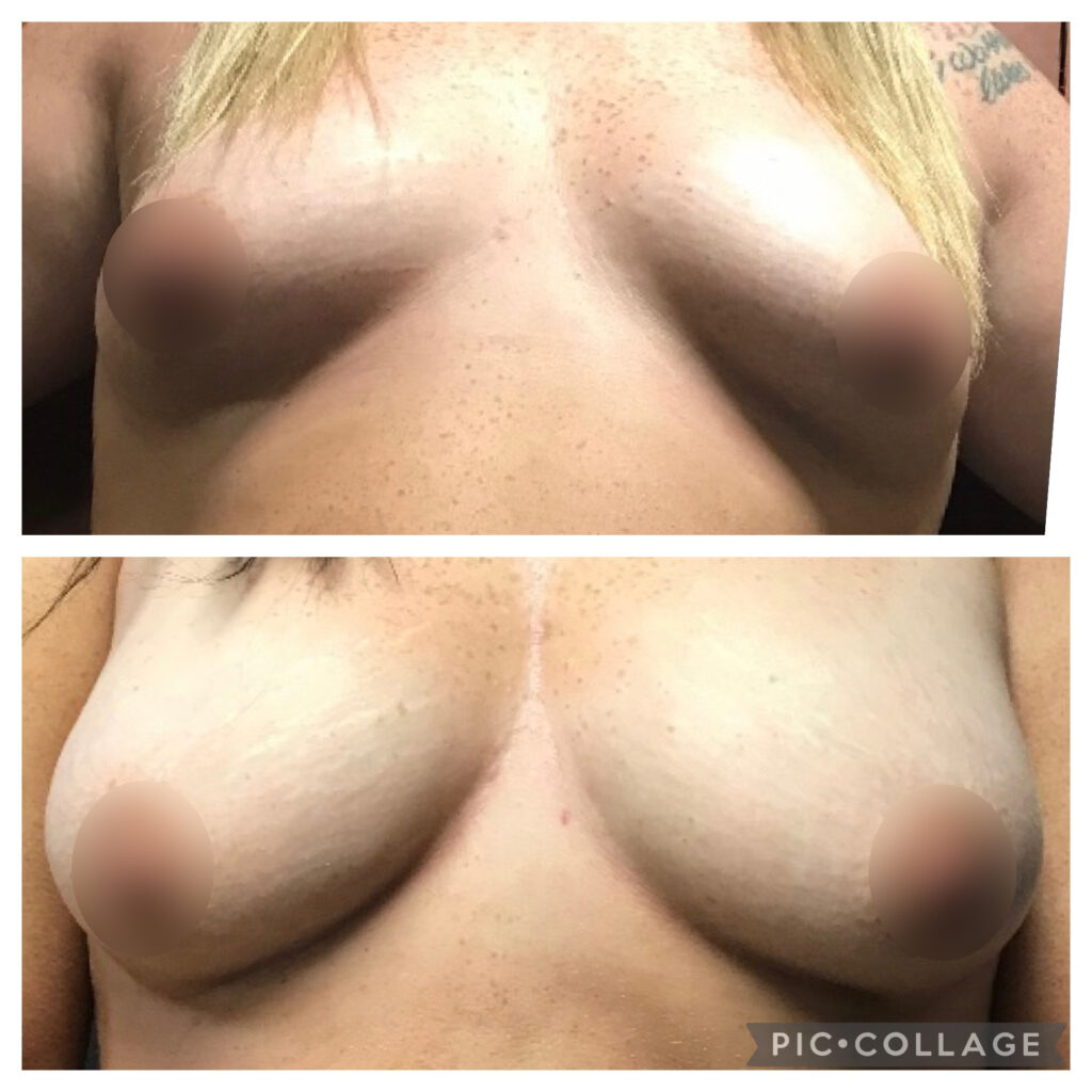 Fat-Transfer-2M-after-blur