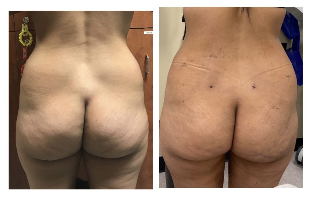 Fat-Transfer-3w-after