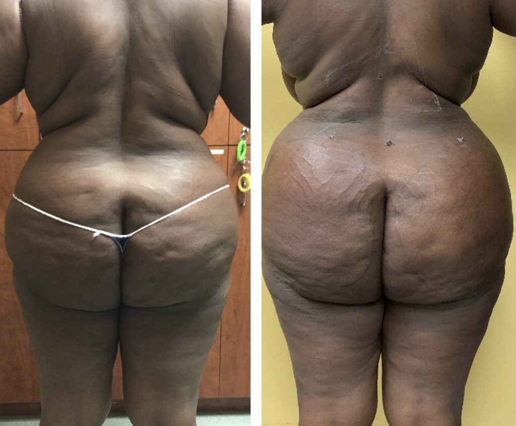 Fat-Transfer-fat-transfer-2-weeks-after