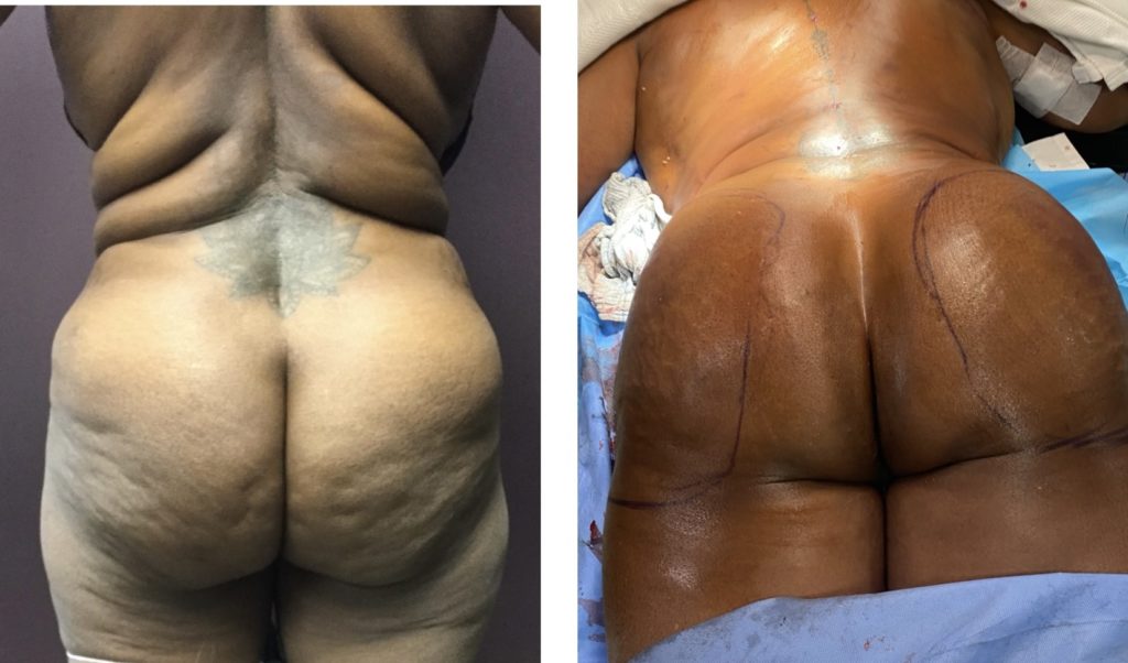 Fat-Transfer-same-day-fat-transfer