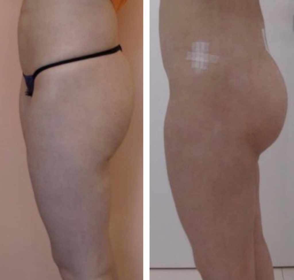 Fat-transfer-10-days-week-after