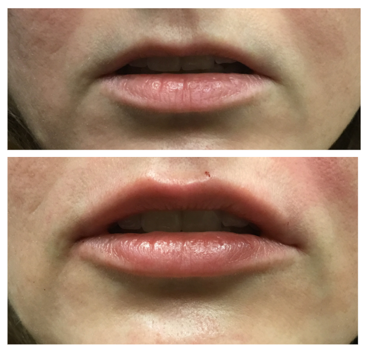 Filler-lipfiller