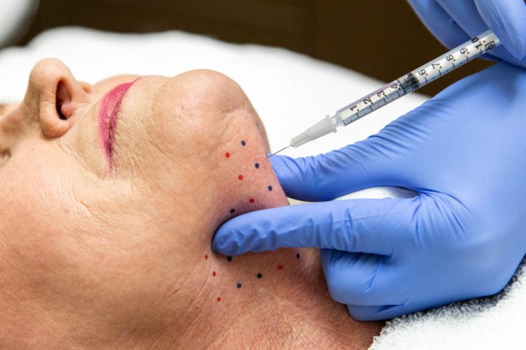 Kybella