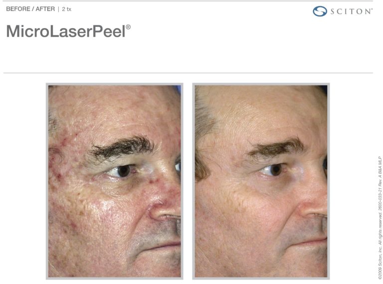 MicroLaserPeel-MLP
