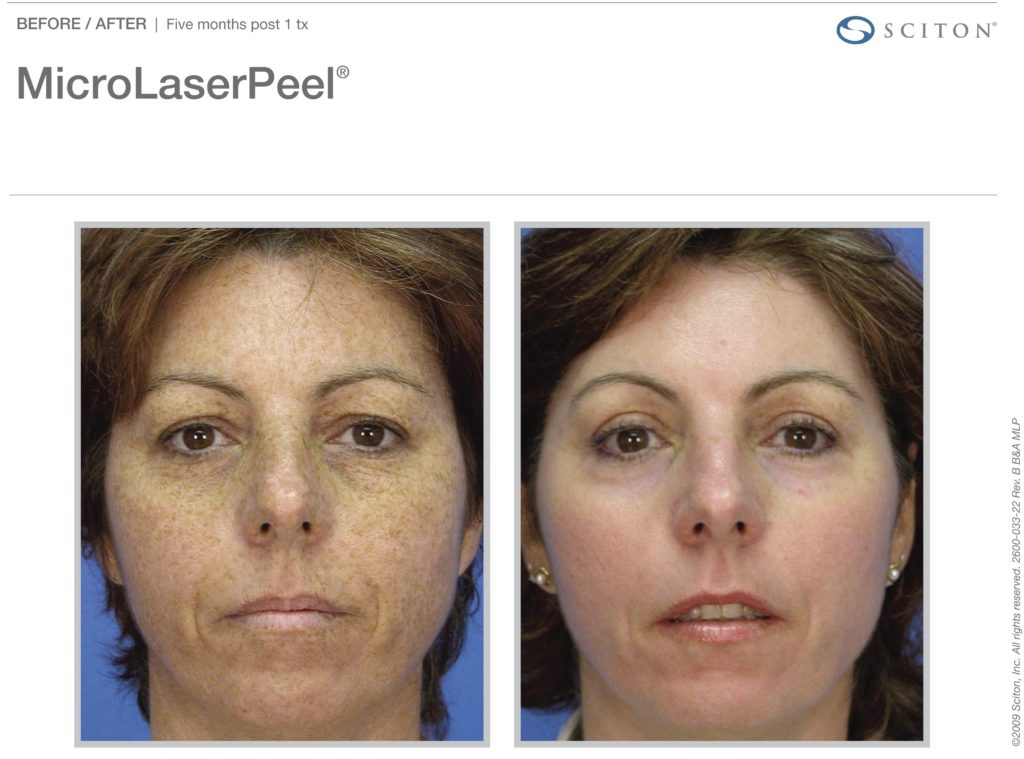 MicroLaserPeel-MLP