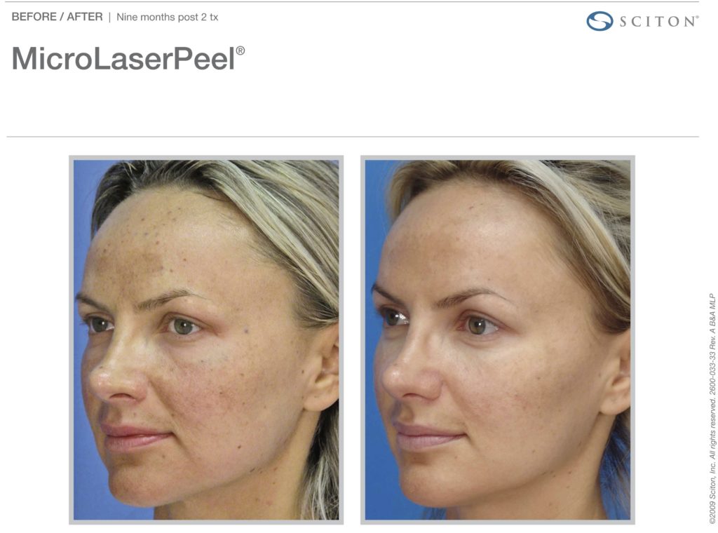 MicroLaserPeel-MLP
