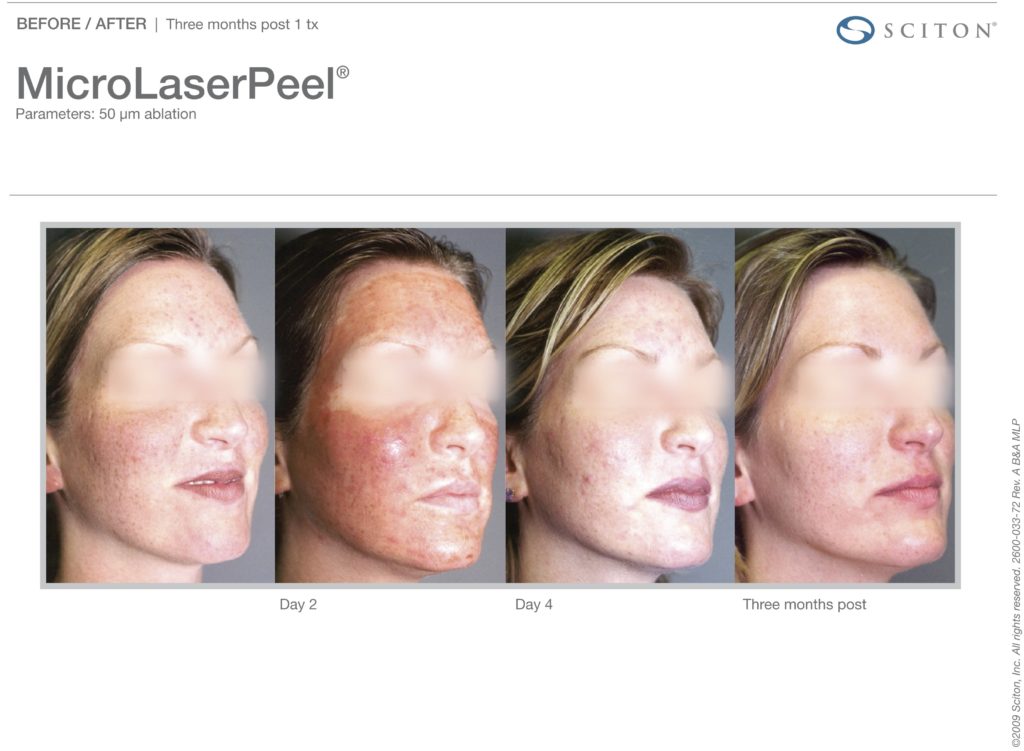 MicroLaserPeel-MLP