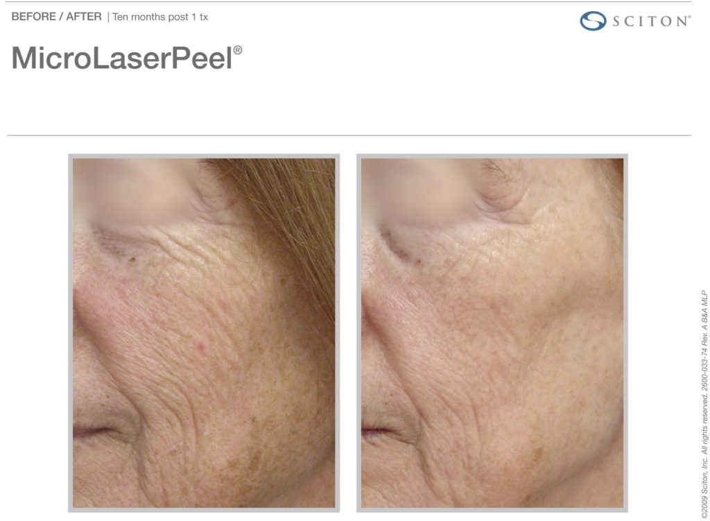 MicroLaserPeel-MLP