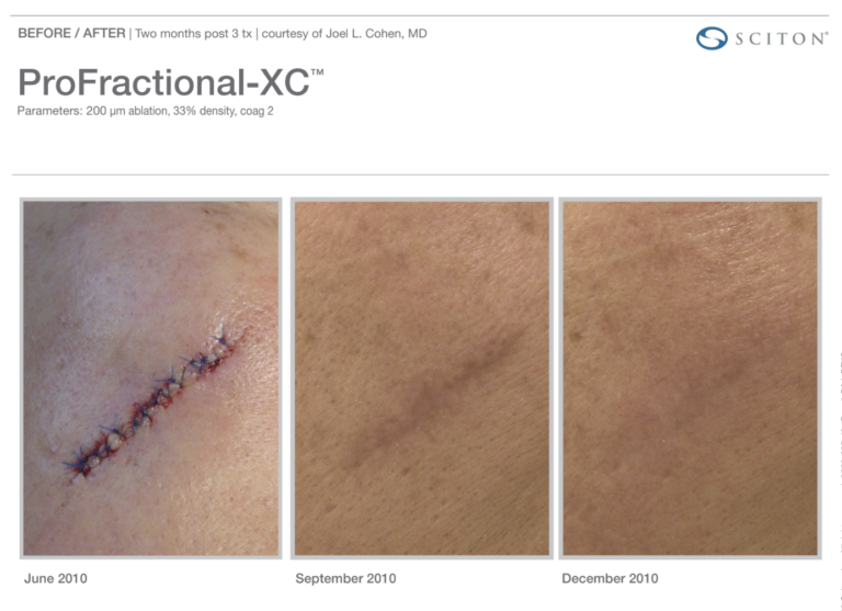 Profractional-BA