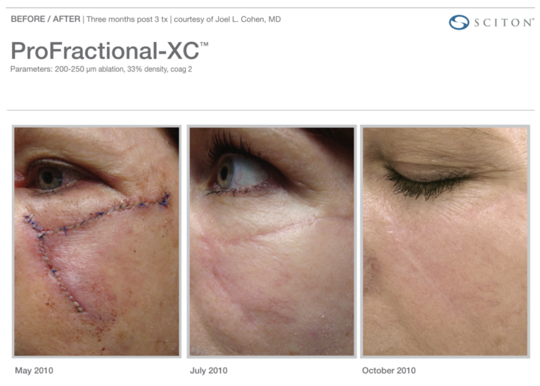 Profractional-BA