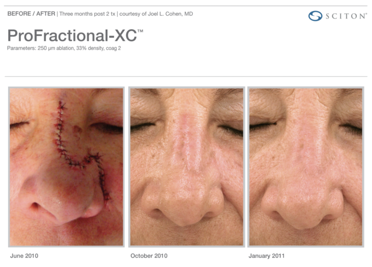 Profractional-BA