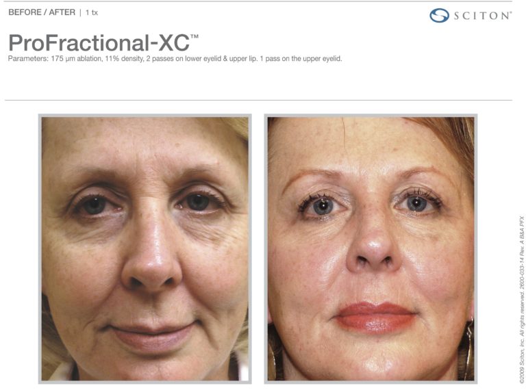 Profractional-BA-ProFXC
