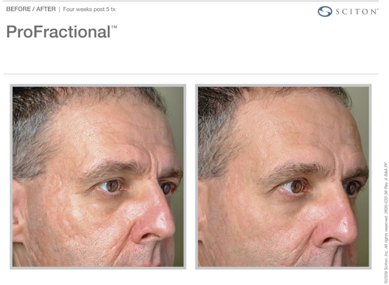 Profractional-BA