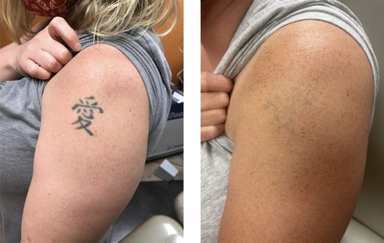 Tattoo-Removal