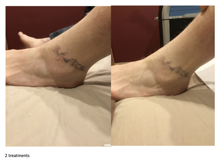 Tattoo-Removal-tattoobeforeafter