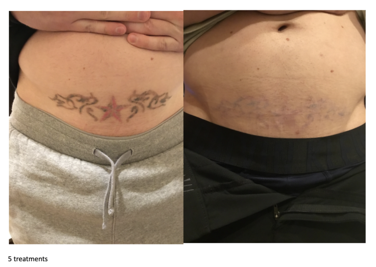 Tattoo-Removal-tattoobeforeafter